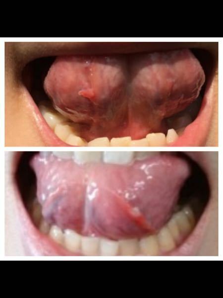 裏 ベロ 物 の 出来 口や舌がピリピリ…お口の中の痛み、原因と対処法は？