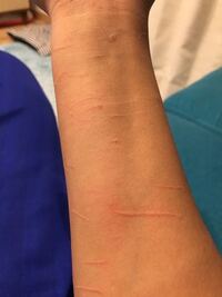 猫にひっかかれるとミミズ腫れになりますが 何故でしょうか 引 Yahoo 知恵袋