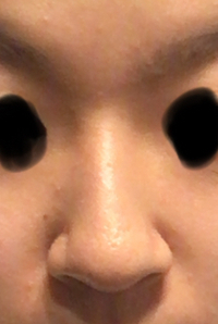 これは団子鼻ですか すっぴんです 鼻先が丸いので団子鼻になりま Yahoo 知恵袋