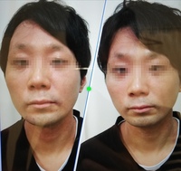 男ですが顔の左右非対称がひどいです 小顔矯正に行った時の画像 Yahoo 知恵袋