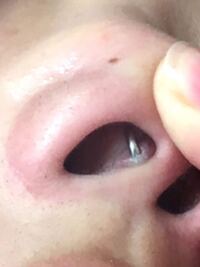 ピアストラブル肉芽 画像汚いです 2週間ほど前に セプ Yahoo 知恵袋