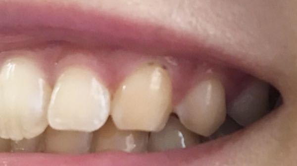 歯茎に黒い点があります 虫歯だと思い 歯医者に行きまし Yahoo 知恵袋