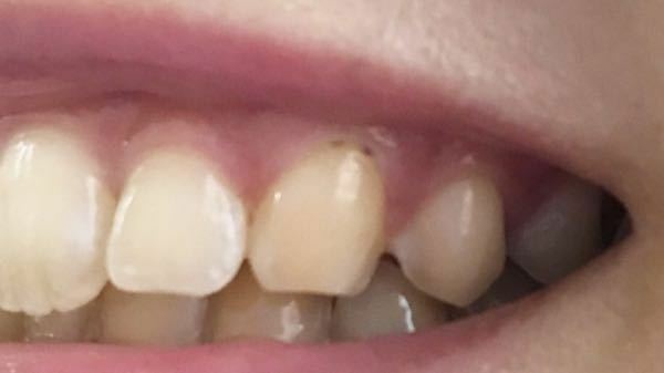 歯茎に黒い点があります 虫歯だと思い 歯医者に行きまし Yahoo 知恵袋