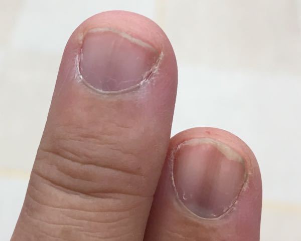 爪甲色素線条またはメラノーマは複数の指の爪に出ることはありま Yahoo 知恵袋