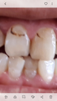 虫歯治療後の変色について 前歯の虫歯治療をずっと前終わらせていて Yahoo 知恵袋