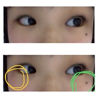 ホクロを除去しようと思っているんですが せっかくなので泣きぼ Yahoo 知恵袋