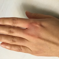 人差し指と中指の間が食事後 急に赤紫になって腫れてきて痒いので優しく触 Yahoo 知恵袋