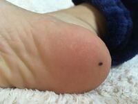 中学生です 今日はじめてかかとにほくろがあることに気づきました Yahoo 知恵袋