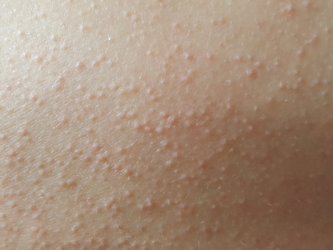 背中のぶつぶつはなんでしょうか かゆいです Tot 今 Yahoo 知恵袋