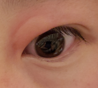 瞼の上がこのように腫れていて とても痒いです なにかのアレルギー Yahoo 知恵袋