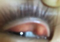 グロい目ですみません 瞼を裏返してみるとこうなってまし Yahoo 知恵袋