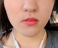 おでこに血管がある人は何でなんですか 余分な皮下脂肪がないからです Yahoo 知恵袋