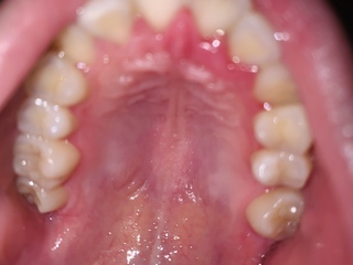 歯の写真すみません これはなんですか 上の前歯の裏の歯茎 が腫れて Yahoo 知恵袋
