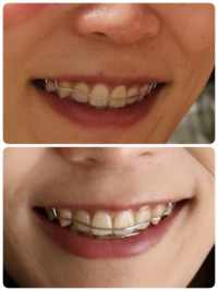 これって多少後戻りしてますよね 上は11月リテーナーに変 Yahoo 知恵袋