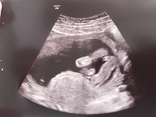 胎児のエコー写真です 16週目股下からの写真です 性別が気になりまして Yahoo 知恵袋