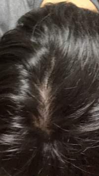 頭皮マッサージをやり始めて3ヶ月ですが禿げていく一方です 育毛剤とか使 Yahoo 知恵袋