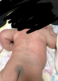 生後3ヶ月の赤ちゃんの身体のあざ 蒙古斑 についてこのよう Yahoo 知恵袋
