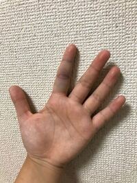 昨日の部活 バスケ でパスカットをする際に突き指をしてしまいました 突 Yahoo 知恵袋