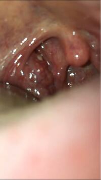 喉の違和感についてです ここ1ヶ月ほど 扁桃腺の奥の方に何か出来 Yahoo 知恵袋