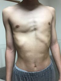 これは漏斗胸でしょうか 歳 165cm 65kgの男です 胸板が薄 Yahoo 知恵袋