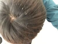 19歳男です 今日友達に言われて気づいたのですが 後頭部あたりの髪の毛 Yahoo 知恵袋