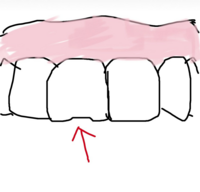 前歯がイラストの矢印のところのように若干かけてしまったのです Yahoo 知恵袋