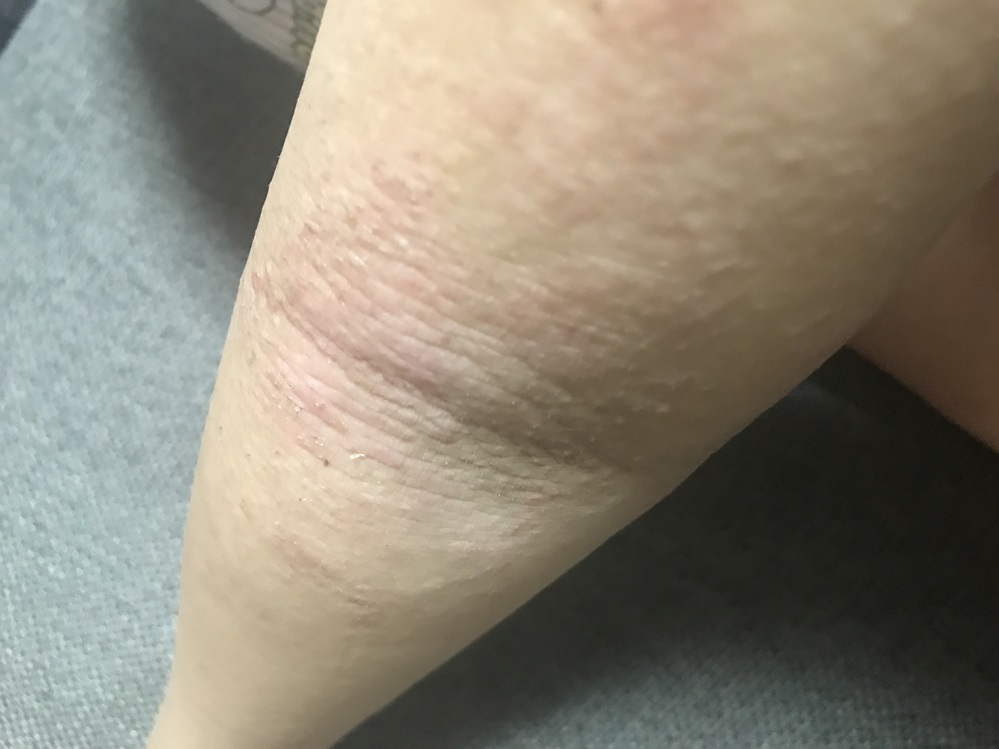 アトピーがひどいです 体育のとき半袖のシャツを着るのが恥ずかしいで Yahoo 知恵袋