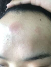 2ヶ月ほど前から額が荒れます 思い当たるのは前髪が当たる仕事上ヘ Yahoo 知恵袋