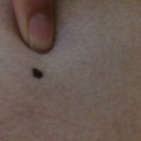 左胸のホクロ昔から左胸あたりにホクロがあるのですが ここ最近一回り大き Yahoo 知恵袋