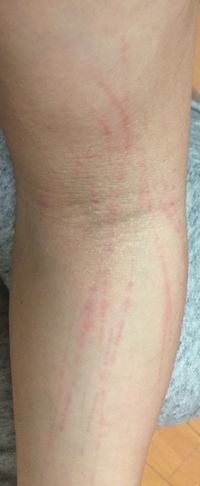 この傷 なんの傷に見えますか 1猫にひっかかれて出来た傷2爪で腕 Yahoo 知恵袋