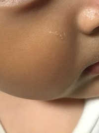 子供の顔にできた傷についての質問です 2ヶ月前 子供が転んだ際におもち Yahoo 知恵袋