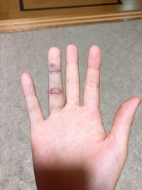 質問です 一昨日部活で突き指してしまいました 今はテーピングで固定して Yahoo 知恵袋