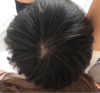 これは薄毛でしょうか それとも普通のつむじでしょうか 普通つむじ Yahoo 知恵袋