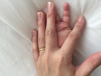 0歳児の手のひらや指と指の間に湿疹 内出血 のような紫の小さい斑点がた Yahoo 知恵袋