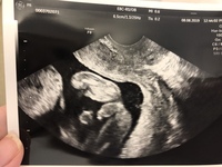 性別判定お願いします ﾍﾟｺｯ妊娠18wのエコー写真なのですが 男の Yahoo 知恵袋