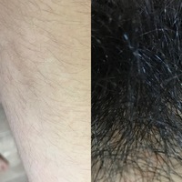 毛深い陰毛画像　剛毛画像　女性 画像閲覧注意】高3女子ですが、お恥ずかしい話、陰毛や腕の毛が剛毛すぎ... - Yahoo!知恵袋