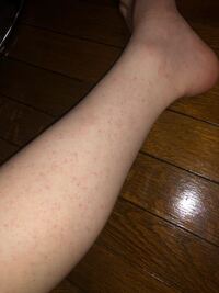 これは 毛穴の炎症ですか 毛を剃ったりしていますか Yahoo 知恵袋