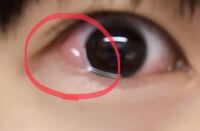 最近よく 結膜浮腫になります ちょっと目を擦っただけでこうな Yahoo 知恵袋