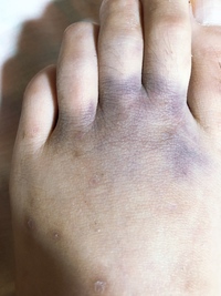 ぶつけたわけでもないのに足の指の付け根が紫色に変色してました 原因が全 Yahoo 知恵袋