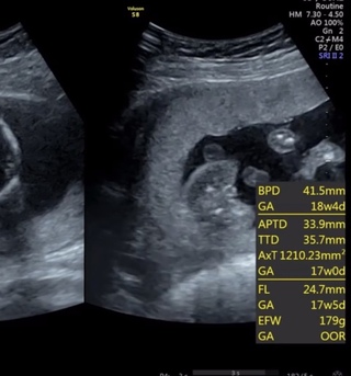 性別判断お願いします 昨日 健診を受けてきた17w4dの妊婦 Yahoo 知恵袋