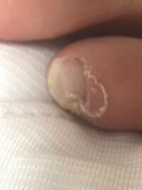 左足の小指が写真のように皮がむけていたのですが これって水虫ですか た Yahoo 知恵袋