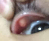 画像参照上瞼の内側に出来物 があるのですが これは何でしょう Yahoo 知恵袋