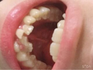 悪い 歯並び