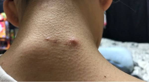 粉瘤 髪の毛 に関するq A Yahoo 知恵袋