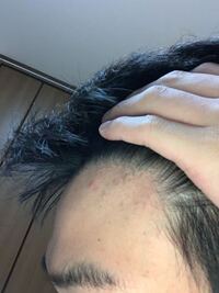 18歳高校生です 最近前髪が後退してきた気がするのですがこれはハゲてい Yahoo 知恵袋