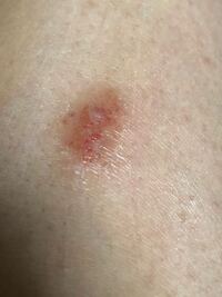 これはどうすれば治りますか 始まりはカミソリ負けだと思うのですが Yahoo 知恵袋