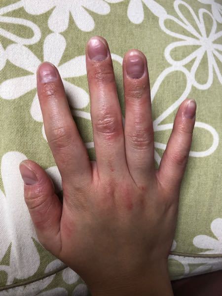 皮膚の病気 アトピー 解決済みの質問 Yahoo 知恵袋