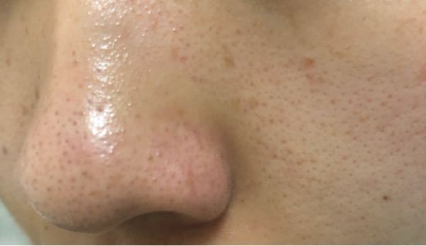 いちご鼻の画像あり 誹謗中傷辞めてください 洗顔後の化粧水 導 Yahoo 知恵袋