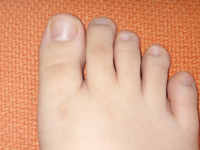 足 親指の付け根 腫れ