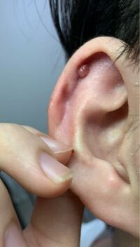 ピアスホールを塞いだ後のケアは何をすればいいですか 膿がひどくてさっき Yahoo 知恵袋